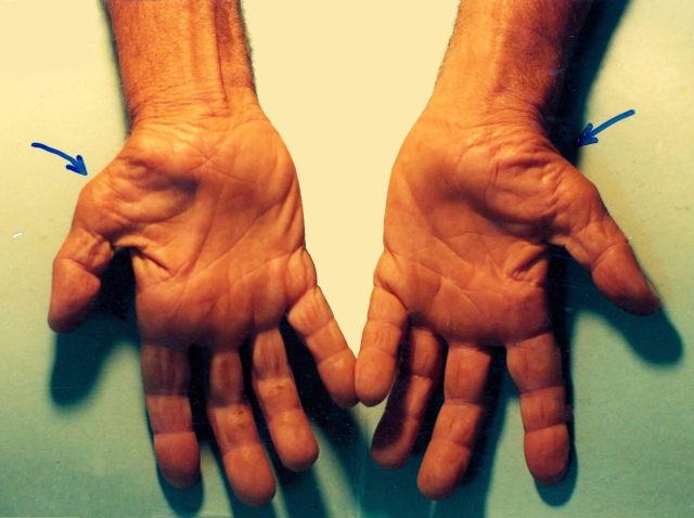 CTS로 인해 근손실이 발생한 환자의 손